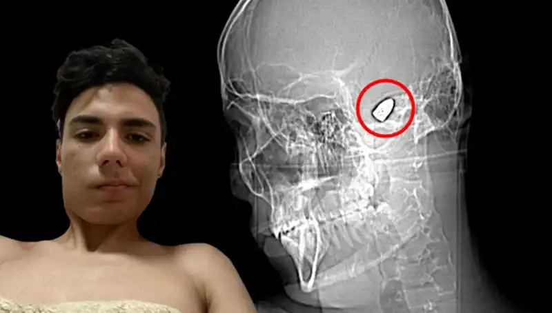 Kafasında Patlayıcı Bir Bomba Taşıyan Genç: Bu Neden Oluyor?